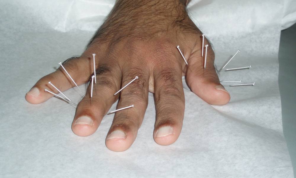 Acupuncture needles placed in the hand